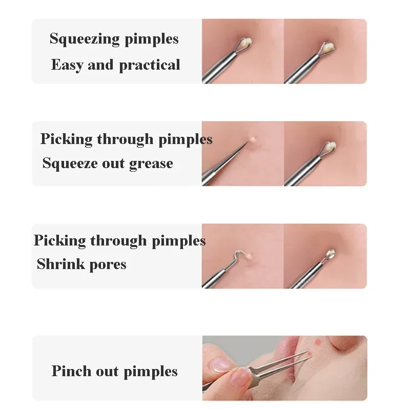 คุณภาพสูงสิว Blackhead Removal - Luxury Skincare Acne บทวิจารณ์และราคา